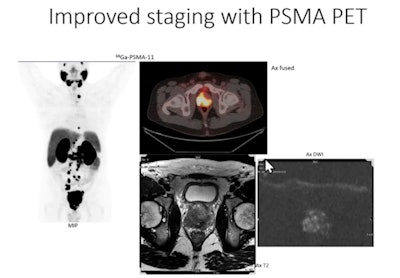 PET/MRI imaging in a patient with prostate cancer illustrating how PET added value in fused images where cancer was difficult to detect on MRI alone. Image courtesy of Lisa Bodei, MD, PhD.