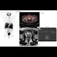 2023 06 09 17 35 2690 2023 06 09 Ismrm Pet Mri Prostate 400