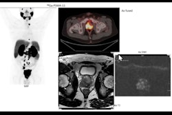 2023 06 09 17 35 2690 2023 06 09 Ismrm Pet Mri Prostate 400