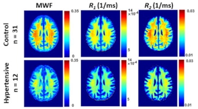 Examples of myelin water fraction and relaxation rates (R1 and R2) parameter maps averaged across participants who are either hypertensive or nonhypertensive (control) drawn from a limited age range (70 to 94 years) to mitigate the effect of age. Results are shown for a representative slice. Visual inspection indicates that overall, hypertensive patients exhibit lower regional MWF, R1 and R2 values, as compared with controls. Image and caption courtesy of John Laporte.