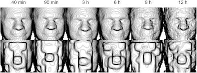 (Top) Faces rendered from PET images at six time points. (Bottom) Rendering of defaced images at each time point. Image courtesy of the Journal of Nuclear Medicine.