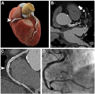 Ultrahigh-resolution (UHR) coronary CT angiography (CCTA) in an 85-year-old man before transcatheter aortic valve replacement. Despite a stent in the right coronary artery and very severe coronary sclerosis with an Agatston score of 4,162, diagnostic visualization of the coronary arteries succeeded, and obstructive coronary artery disease was excluded on CT images. (A) Three-dimensional cinematic rendering of the heart. The stent (arrowhead) is visible in the middle segment of the right coronary artery. (B) UHR CCTA with 0.2-mm axial sections. The lumen (arrow) of the severely calcified distal left anterior descending artery can be assessed without artifacts. (C) Curved multiplanar reformations of the right coronary artery with a diagnostic display of the stent lumen (arrowhead). (D) Invasive coronary angiography enables exclusion of in-stent stenosis. Image and caption courtesy of the RSNA.