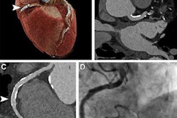 2023 06 15 22 38 2546 2023 06 20 Pcct Cardiac 20230615220331