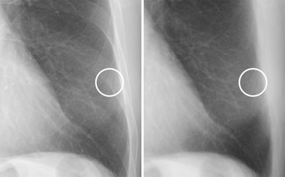 A case of a calcified nodule overlapping with the bone. On the standard image (left), the presence or absence of calcification among five readers was not consistent (confidence level of each reader: 4, 3, 3, 4 and 2). In the soft tissue image (right), the nodule disappeared. All readers correctly evaluated it as calcified (confidence level of each reader: 1, 1, 2, 2 and 2). Image and caption courtesy of Scientific Reports through CC BY 4.0.