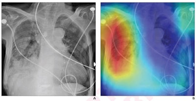 (A) chest x-ray of a 78-year-old female showing diffuse consolidation of the right lung, consistent with CAP. The DL model predicted a risk of 30-day mortality of 42%. (B) Gradient-weighted class activation map from DL model shows that model prediction was influenced by right lung (red color), corresponding with area of image involved by pneumonia. The patient's CURB-65 score was 2. The patient died 11 days after diagnosis of pneumonia. Image and caption courtesy of the American Journal of Roentgenology through CC BY 4.0.