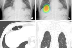 2023 06 22 21 33 8589 2023 06 27 Ai Chest Cancer 20230622214228