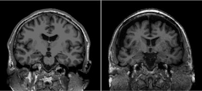 General age-related loss of brain matter aggravated by social isolation on T1-weighted cranial MRI of a 50-year-old (left) and 85-year-old (right).