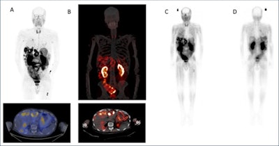(A) Ga-68 DOTA-5G PET/CT images (1 hour post injection). (B) Lu-177 DOTA-ABM-5G SPECT/CT images (1 day post injection). (C) Lu-177 DOTA-ABM-5G whole body planar image (anterior, 1 day post injection). (D) Lu-177 DOTA-ABM-5G whole body planar image (posterior, 1 day post injection). Image courtesy of Julie Sutcliffe, PhD.