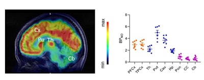 Clinical translation of F-18-Cholestify in healthy volunteers showed representative PET and non-displaceable binding potential in humans. The graph shows correlations of regional PET signal (SUV) with nondisplaceable binding potential values and Western blot analysis of CYP46A1 from post-mortem brain specimens. Images courtesy of the SNMMI.