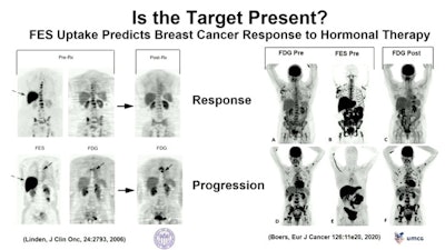 PET scans with an F-18 FES-PET radiotracer can reveal the target for therapy, as well as whether the therapy is working in patients with HER2-positive breast cancer. Image courtesy of David Mankoff, MD, PhD.