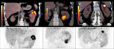 CAIX-targeted PET/CT with Zr-89-DFO girentuximab allows for the visualization and characterization of renal masses with great image contrast, according to a study presented at the SNMMI annual meeting. Researchers said that the tracer shows high uptake in clear cell renal carcinoma lesions and low background activity in the normal renal parenchyma and other normal organs. Images courtesy of the SNMMI.