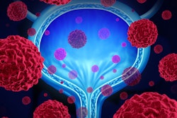 2023 06 26 21 16 1234 Bladder Cancer 400