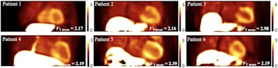 VT images for six patients generated from 30 minutes of dynamic data. Mean VT values of myocardium are shown on the bottom right. Images courtesy of Qiong Liu and the SNMMI.