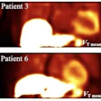 2023 06 26 23 10 0347 2023 06 27 Snmmi Cardiac Amyloidosis Fig6 20230626230535