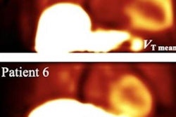 2023 06 26 23 10 0347 2023 06 27 Snmmi Cardiac Amyloidosis Fig6 20230626230535