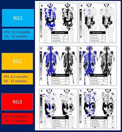 Outcomes from response groups based on PSA levels and Lu-177 SPECT at six weeks. Image courtesy of Andrew Nguyen, MBBS, and the SNMMI.