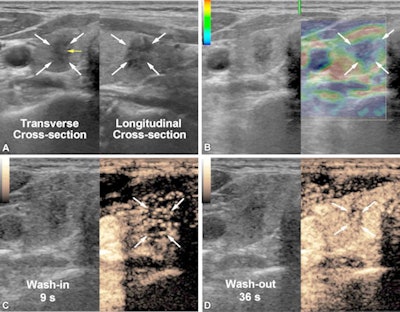 (A) Imaging shows conventional ultrasound in a 49-year-old female participant with a thyroid nodule (white arrows) detected on a previous ultrasound image two weeks prior. The nodule is solid, hypoechoic, and taller than wide with the punctate echogenic foci (yellow arrow) and lobulated margin in the right lobe. The maximum diameter is 10 mm. The American College of Radiology TI-RADS system is TR5 level. The proportion of cystic component is 0%. (B) The elastogram shows blue to indicate stiffness (arrows in transverse cross-section) in the nodule. (C) The CEUS image (nine seconds, the start of the wash-in period of the thyroid nodule) shows early-phase hypoenhancement intensity (arrows on transverse cross-section) with slow-infusion wash-in mode. (D) CEUS imaging (36 seconds, the end of the maximum enhancement and the start of the wash-out period in the thyroid parenchyma) shows heterogeneous enhancement uniformity (arrows on transverse cross-section). The whole CEUS shows low blood volume. Both the predicted value (0.9) according to the nomogram of the multimodaluty model and the management of TI-RADS recommended fine-needle aspiration to the thyroid nodule. The final pathologic diagnosis was papillary thyroid carcinoma, and the participant underwent microwave ablation to the thyroid nodule. Images and caption courtesy of RSNA.