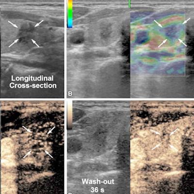 2023 06 27 23 08 7077 2023 06 27 Ultrasound Thyroid Multimodal 20230627230924