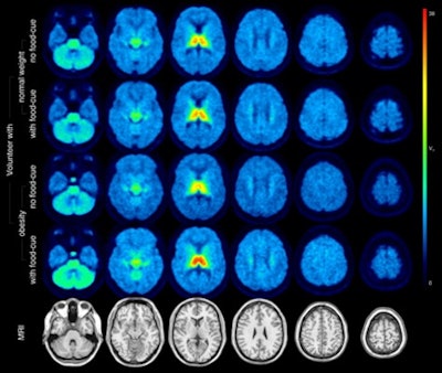 Distribution volumes of a4b2 nicotinic acetylcholine receptors in the brain of normal-weight volunteers and volunteers with obesity. Image courtesy of Swen Hesse, MD.