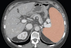 2023 06 29 20 22 4838 2023 06 29 Ajr Ct Spleen 400