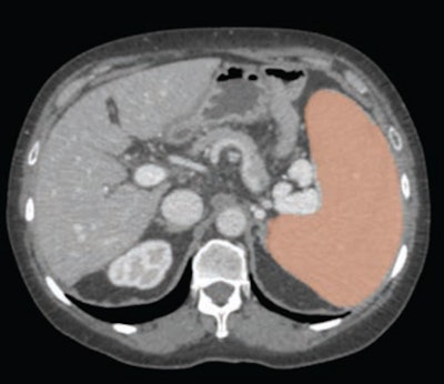 60-year-old woman with cirrhosis and portal hypertension who underwent contrast-enhanced CT as pre-liver transplant evaluation. Patient weight was 164 lbs. Automated deep-learning artificial intelligence tool was used to segment spleen and thereby compute splenic volume. Axial image shows spleen segmentation (orange overlay). Automated splenic volume was 1,097 ml, above weight-based splenic volume threshold for determining splenomegaly of 350 ml. True-craniocaudal splenic length was 15.5 cm, and maximum-3D splenic length 18.7 cm. These length measurements would indicate presence of splenomegaly at all thresholds used. Image and caption courtesy of the American Journal of Roentgenology.