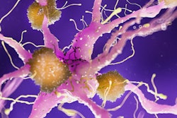 2021 11 20 00 07 5698 Amyloid Plaque Alzheimer2 400