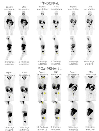 PET maximum intensity projections (MIP) of example cases in a test set with high (left), intermediate (middle), and low (right) agreement between manual expert annotation and the automated convolutional neural network (CNN)-based annotation of sites suspicious for cancer (overlayed in yellow wherever visible in the PET MIP). The number of annotated findings and miTNM nodal and metastatic stage are reported. Image courtesy of Nicolo Capobianco, PhD.