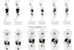 2023 06 29 23 13 9451 2023 06 30 Psma Pet Ai 20230629234007