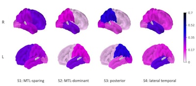 Right and left hemisphere brain surface plots showing the strength of the canonical vector, for each subtype. Image and caption courtesy of Joyita Dutta, PhD, and the SNMMI.