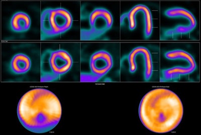 Image showing abnormal F-18 flurpiridaz PET (stress top, rest bottom) for a 60-year-old female with body mass index of 46 kg/m2; subsequent angiography showed significant blockage in right coronary artery.