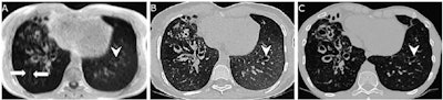 Example images of the lung in a 21-year-old male patient with cystic fibrosis from the external validation data set. (A) Scan acquired with lung MRI with ultrashort echo time (UTE) shows motion artifacts on the right side (arrows). These artifacts were not observed on (B) the synthetic CT image generated by artificial intelligence from the UTE MRI scan, and the rest of the reconstructed image was not affected. Bronchiectasis of the left lower lobe (arrowhead) was visually missed at UTE MRI, leading to a false-negative depiction of bronchiectasis, but it is clearer on the synthetic CT scan and confirmed on the (C) corresponding real CT scan. Images and caption courtesy of the RSNA.