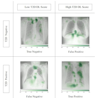 Occlusion maps identifying key features in representative chest x-rays with high and low diagnostic scores. Dark green pixels highlight significant features for model prediction, primarily associated with cardiomediastinal, upper abdominal, lower neck, and supraclavicular regions. Examples of CXRs with high and low diagnostic scores are presented. Image and caption courtesy of Nature Communications through CC BY 4.0.