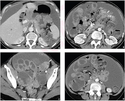 A 62-year-old woman who underwent pretreatment CT for suspected advanced ovarian cancer. A simple structured CT report described the presence of peritoneal implants in six anatomic locations. The disease was considered resectable based on the CT report, and primary debulking surgery was performed. However, the surgery yielded suboptimal resection. Axial contrast-enhanced images from pretreatment CT show disease involvement of sites of residual disease at surgery that were not mentioned in the report, including the gastric wall (stars, A), colonic wall (arrows, B and C), and small bowel mesentery (arrowhead, D). Images and caption courtesy of AJR.