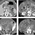 2023 07 12 19 50 6142 2023 07 12 Ajr Ct Ovarian 400
