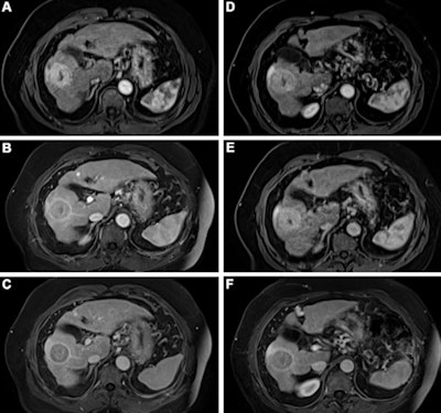 Contrast-enhanced MRI of the liver after administration of gadopiclenol (0.05 mmol/kg) and gadobutrol (0.1 mmol/kg). Axial 3D T1-weighted dynamic contrast-enhanced MRI scans during the (A, D) arterial, (B, E) portal venous, and (C, F) delayed phases in a 66-year-old man with hepatocellular cancer. Images were obtained after administration of gadopiclenol at 0.05 mmol/kg (in A, B, and C) or gadobutrol at 0.1 mmol/kg (in D, E, and F). Images and caption courtesy of the RSNA.