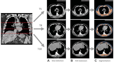 Example of fully automated body composition assessment in the lung cancer screening noncontrast low-dose chest CT scan in a 57-year-old male participant. (A) CT axial plane levels corresponding to the fifth (T5), eighth (T8), and 10th (T10) vertebral bodies were predicted. Corresponding axial CT sections were selected for body composition assessment. (B) The field of view (FOV) of each CT section with body section truncation was extended with missing body section imputation. (C) Areas of subcutaneous adipose tissue (SAT) (blue) and skeletal muscle (SM) (orange) were segmented on the field-of-view extended sections. Body composition measurements include SM index (166.2, normal group), SM attenuation (17.5 HU, lower group), SM SD (41 HU, normal group), SAT index (189.7, higher group), SAT attenuation (-88.4 HU, normal group), and SAT SD (28 HU, higher group). Indexes were calculated as summed area (in square centimeters) across three levels divided by participant height squared (in square meters). Images and captions courtesy of the RSNA and Kaiwen Xu.