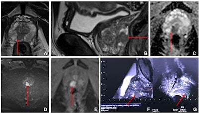 Images from multiparametric MRI of the prostate in a 60-year-old male participant show a focal lesion (arrow) in the right peripheral zone of the prostate at the mid-gland level. The lesion had low T2 signal on (A) axial and (B) sagittal T2-weighted MRI scans, marked corresponding restricted diffusion on (C) apparent diffusion coefficient and (D) high-b-value diffusion-weighted MRI scans, and (E) early contrast enhancement on a dynamic contrast-enhanced MRI scan. The lesion was a maximum of 13 mm on transverse axis with a bulge of the prostatic outline but no definite extraprostatic extension. This was scored as Prostate Imaging Reporting and Data System 4. Fused (F) isovolumetric T2 sequence with (G) US image. Square marker A is placed at the level of proximal prostatic urethra as an anatomic landmark. Fusion core showed a Gleason score of 3+4 prostate cancer. Images and caption courtesy of the RSNA.