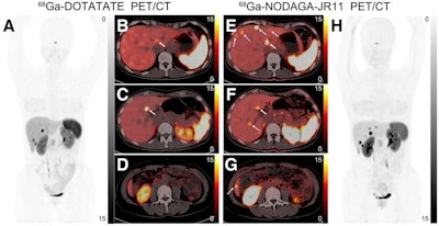 Ga-68 DOTATATE and Ga-68 NODAGA-JR11 PET/CT images are shown of a postoperative gastric neuroendocrine tumor patient with multiple liver metastases. (A) Ga-68 DOTATATE maximum-intensity projection shows several liver lesions with high uptake. (B) Transaxial fusion image appears to show abnormal moderate-uptake lesion (arrow) in high liver background uptake. (C and D) One transaxial fusion image (C) shows liver metastasis (arrow), whereas no liver lesion was found in another (D). (H) Ga-68 NODAGA-JR11 maximum-intensity projection shows many more liver lesions than Ga-68 DOTATATE. (E-G) Transaxial fusion images at same three levels as in B-D similarly found liver lesions that matched those on Ga-68 DOTATATE (solid arrows). Ga-68 NODAGA-JR11 PET/CT shows lower liver background uptake and additional liver metastases (dashed arrows) at sites that were negative on Ga-68 DOTATATE PET/CT. Image courtesy of the Journal of Nuclear Medicine.