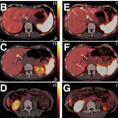 New PET radiotracer shows promise in NETs | AuntMinnie