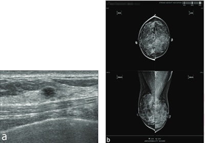 Images show results for a 57-year-old woman with dense breasts. Screening mammography (not shown) was assessed as BI-RADS category 2. (A) Supplementary screening breast ultrasound performed on same day as the mammogram shows a 4-mm round hypoechoic mass with angular margins in the right upper medial breast. (B) A screenshot shows the output of an AI tool, which assigned an abnormality score of 'low' in each breast. Ultrasound-guided core biopsy and surgery showed an invasive ductal carcinoma, not otherwise specified (Luminal A, histologic grade I). This case represents a false-negative AI result. Image courtesy of ARRS.