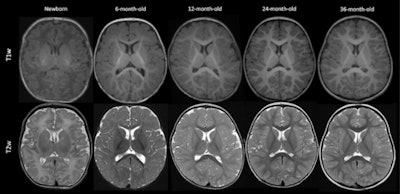 Axial T1-and T2-weighted (T1w and T2w, respectively) MRIs of infants and young children with normal myelin maturation at the level of corpus callosum and lateral ventricles. Note that the images are resized to keep the focus only on progression of myelin maturation at different months. (A) A term newborn with meconium aspiration syndrome who underwent imaging to rule out ischemia, infarction, or hemorrhage. (B) A 6-month-old infant with a history of asphyxia and sinus vein thrombosis at birth but with normal development. (C) A 12-month-old child with an ocular hemangioma who underwent imaging to rule out intracranial pathology. (D) A 24-month-old child with headache for 2 months. (E) A 36-month-old child with a history of focal seizures, imaging is performed to rule out structural changes. Images and caption courtesy of the RSNA.