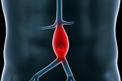 2019 12 10 00 31 4099 Abdominal Aneurysm 400