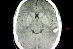 2021 10 14 16 04 5556 Ct Intracerebral Hemorrhage 400