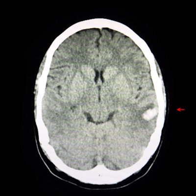 2021 10 14 16 04 5556 Ct Intracerebral Hemorrhage 400