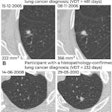 2023 08 02 17 12 9668 2023 08 02 Prior Ct Lung Nodules Figure5 20230802175930