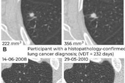 2023 08 02 17 12 9668 2023 08 02 Prior Ct Lung Nodules Figure5 20230802175930
