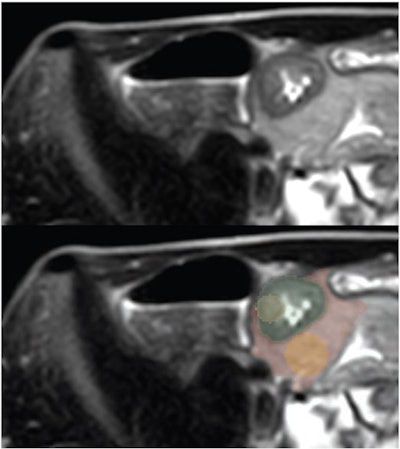 17-year-old patient with Crohn disease. Axial T2-weighted SSFSE images show greatest terminal thickness -- without (top) and with (bottom) four ROI segmentations. (Green = whole-bowel ROI; yellow = bowel-core ROI; red = whole-fat ROI; orange = fat-core ROI.) Image and caption courtesy of the American Journal of Roentgenology.