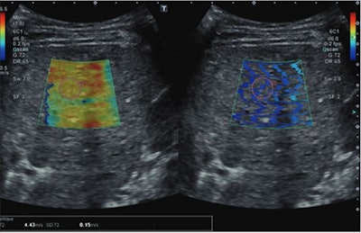 Ultrasonic images show a 15-year-old patient with prior Fontan circulation and high initial liver stiffness (4.43 m/s). The patient subsequently developed Fontan circulatory failure during follow-up at age 19 and underwent heart transplantation. The left image is a color elastogram (scale to left), and the right image is wave propagation image, reflecting quality of shear-wave acquisition. The pink circle indicates the sample region of interest. Image courtesy of the ARRS.