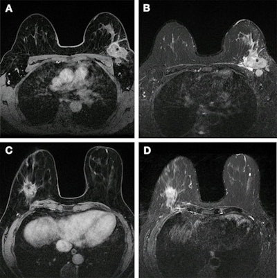 Images show breast cancer in two women at baseline multiparametric MRI. (A) Image shows axial delayed-phase dynamic contrast-enhanced MRI scan in a 51-year-old woman with luminal B no special type carcinoma in the left breast 240 seconds after gadolinium chelate injection. (B) Image shows axial T2-weighted image in the same woman as in (A). At core biopsy, the lesion was considered as HER2 low. The lesion was correctly classified by the radiomic signature (0.87 ≥ threshold). (C) Image shows axial delayed-phase dynamic contrast-enhanced MRI scan in a 43-year-old woman with luminal B no special type carcinoma in the right breast 240 seconds after gadolinium chelate injection. (D) Image shows axial T2-weighted image in the same woman as in (C). At core biopsy, the lesion was considered as HER2 zero. The lesion was correctly classified by the radiomic signature (0.45 < threshold). Images and caption courtesy of the RSNA.