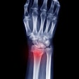 2023 08 08 16 58 4346 Distal Radius Fracture 400